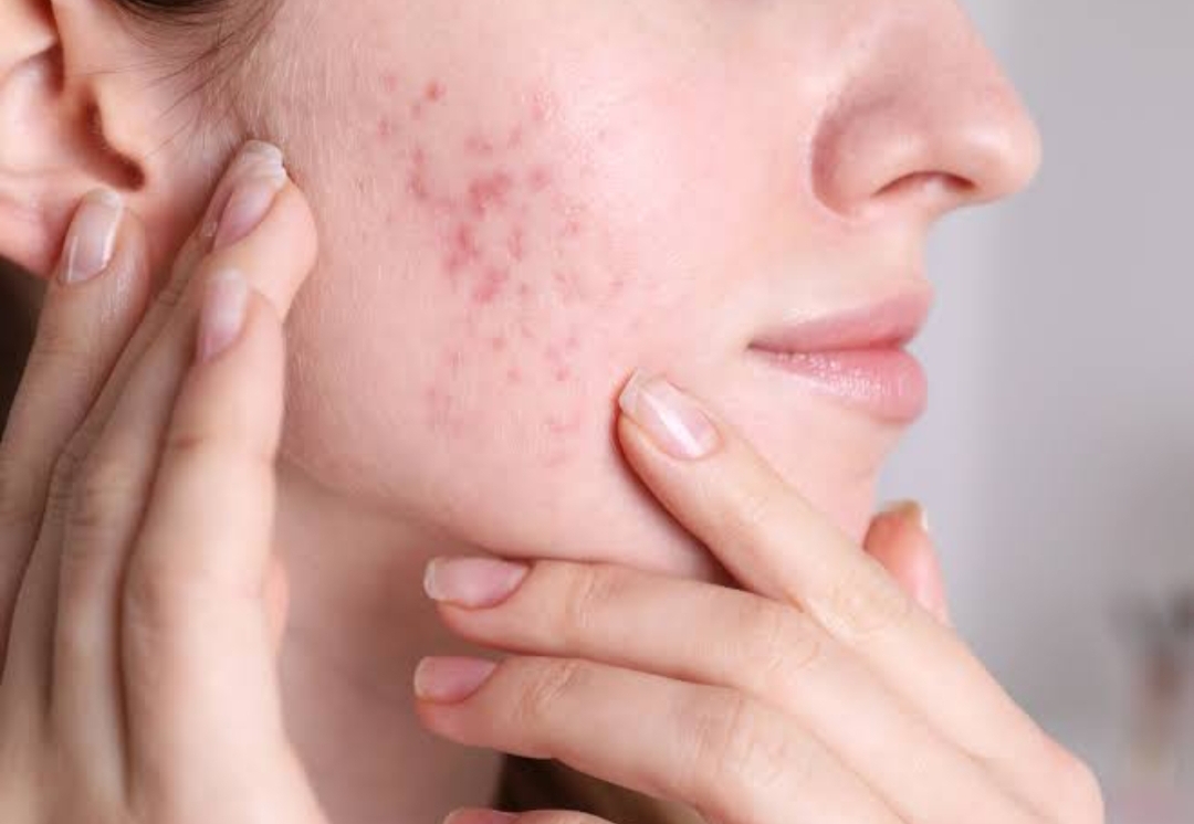 Acne & Acne Scar Treatment - Dermatologist in Kothrud, Pune